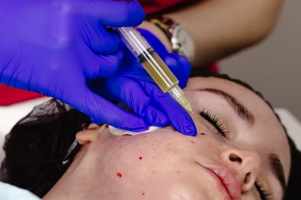 PRP Treatment - Laccura